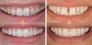 Close-up of teeth before and after bonding treatment showing improved shape, color, and alignment.