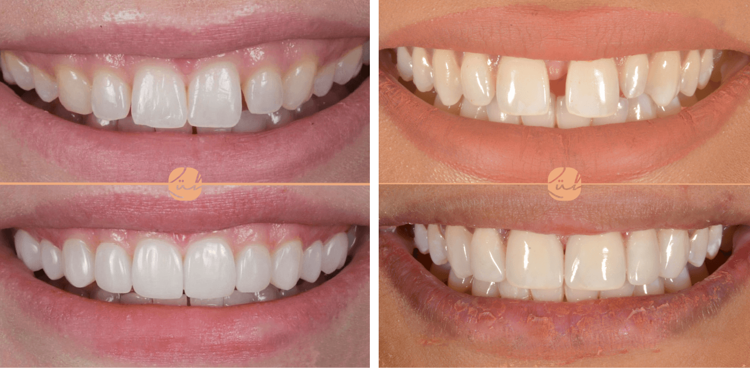 Close-up of teeth before and after bonding treatment showing improved shape, color, and alignment.