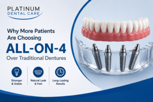 Illustration of All-on-4 dental implants supporting a full arch of replacement teeth, showing why they are a more stable alternative to traditional dentures.